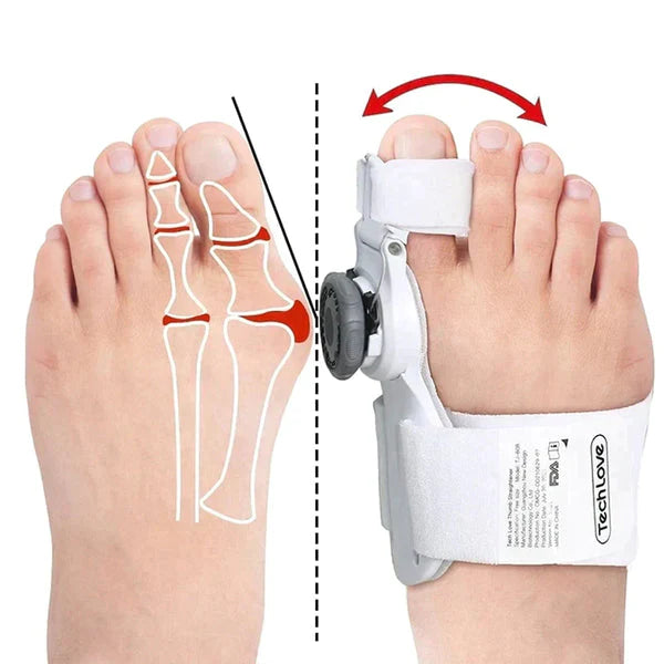 Alignix™ – Universele hallux valgus corrector | 50% korting