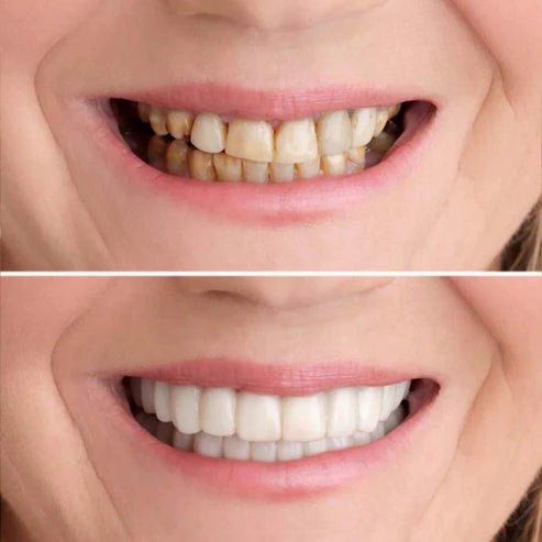1 + 1 Gratis | SmileFix™ Creëer het perfecte gebit [Laatste dag korting]