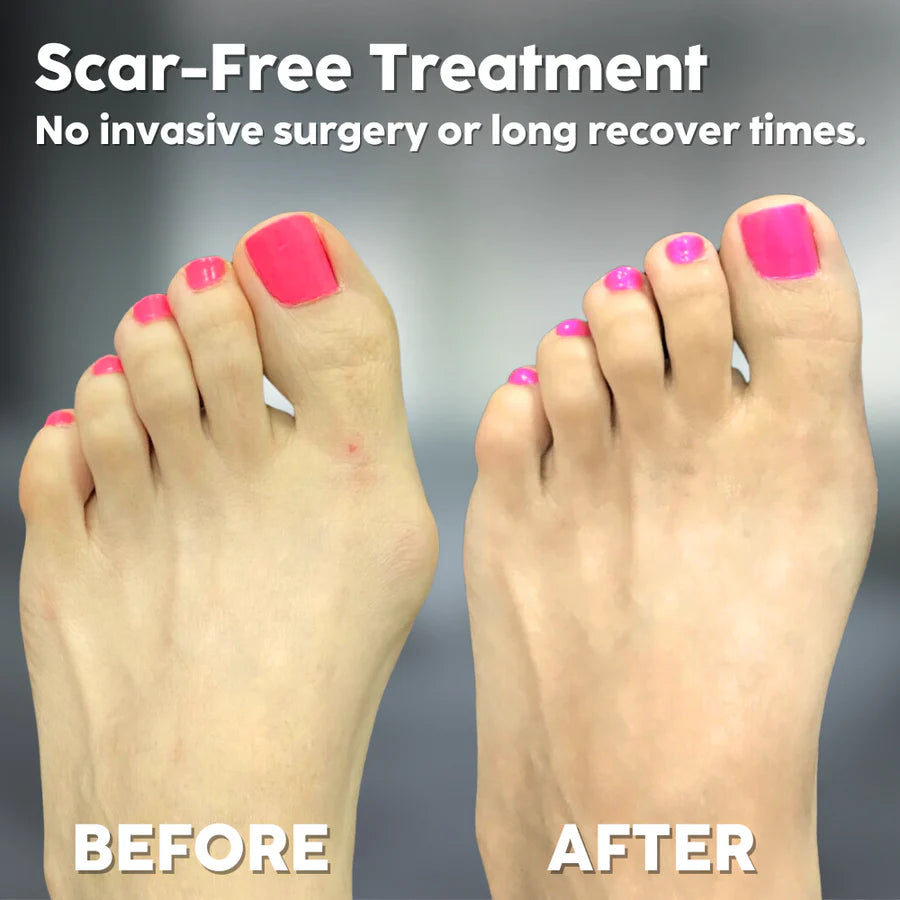 Alignix™ – Universele hallux valgus corrector | 50% korting
